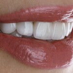 An Example of Enamel Bonding is the Placement of a Dental Veneer – The Stunning Secret to a Hollywood Smile